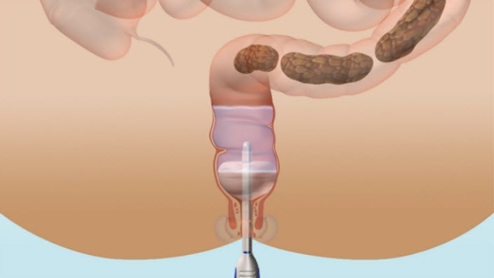peristeen anal plug usa Peristeen anal plug usa